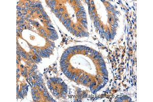 Immunohistochemistry of Human ovarian cancer using IGFBP7 Polyclonal Antibody at dilution of 1:50 (IGFBP7 antibody)
