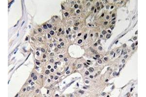 Immunohistochemistry analyzes of Defensin alpha-1 antibody in paraffin-embedded human breast carcinoma tissue. (alpha Defensin 1 antibody)