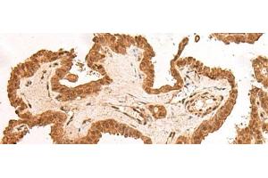 Immunohistochemistry of paraffin-embedded Human thyroid cancer tissue using ARMC8 Polyclonal Antibody at dilution of 1:40(x200)