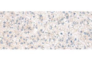Immunohistochemistry of paraffin-embedded Human liver cancer tissue using ANKS6 Polyclonal Antibody at dilution of 1:55(x200) (ANKS6 antibody)