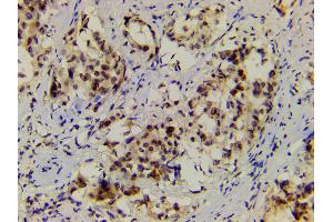 ABIN6267554 at 1/200 staining human lung cancer tissue sections by IHC-P.