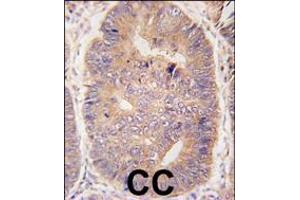 Formalin-fixed and paraffin-embedded human colon carcinoma tissue reacted with hTASP1-C-term , which was peroxidase-conjugated to the secondary antibody, followed by DAB staining.