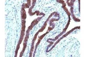 Formalin-fixed, paraffin-embedded human ovarian carcinoma stained with EpCAM antibody (EGP40/1110). (EpCAM antibody  (Cytoplasmic Domain))