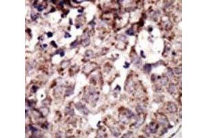 IHC analysis of FFPE human breast carcinoma tissue stained with the RAGE antibody (RAGE antibody  (AA 29-59))