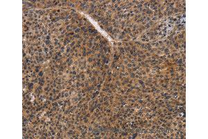 Immunohistochemistry of Human liver cancer using CDC34 Polyclonal Antibody at dilution of 1:50 (CDC34 antibody)