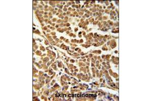 ZNF313 Antibody immunohistochemistry analysis in formalin fixed and paraffin embedded human skin carcinoma followed by peroxidase conjugation of the secondary antibody and DAB staining. (RNF114 antibody  (C-Term))