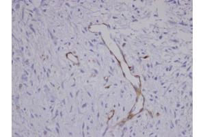 IHC-P Image Immunohistochemical analysis of paraffin-embedded human Sarcoma meta to brain Blood Vessel, using CORO1C , antibody at 1:100 dilution. (CORO1C antibody  (C-Term))