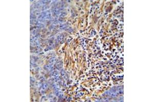 Immunohistochemistry analysis in formalin fixed and paraffin embedded human lung carcinoma reacted with HLA-DRB5 Antibody (Center) followed which was peroxidase conjugated to the secondary antibody and followed by DAB staining. (HLA-DRB5 antibody  (Middle Region))