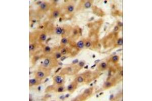 Immunohistochemistry analysis in formalin fixed and paraffin embedded human hepatocarcinoma reacted with GAGE13 Antibody (N-term) followed by peroxidase conjugation of the secondary antibody and DAB staining. (G Antigen 13 antibody  (N-Term))