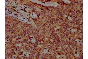 IHC image of ABIN7152402 diluted at 1:500 and staining in paraffin-embedded human liver cancer performed on a Leica BondTM system. (Cyclin F antibody  (AA 248-400))