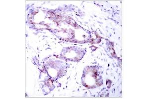 Immunohistochemical analysis of paraffin- embedded human breast carcinoma tissue, using Myc (phospho-Ser373) antibody (E011036). (c-MYC antibody  (pSer373))