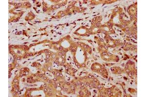 IHC image of ABIN7161592 diluted at 1:300 and staining in paraffin-embedded human liver cancer performed on a Leica BondTM system. (QPRT antibody  (AA 113-254))