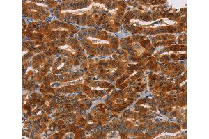 Immunohistochemistry of Human liver cancer using NCR1 Polyclonal Antibody at dilution of 1:30 (NCR1 antibody)