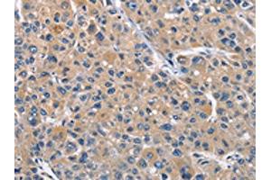 The image on the left is immunohistochemistry of paraffin-embedded Human liver cancer tissue using ABIN7128963(CLEC2D Antibody) at dilution 1/70, on the right is treated with fusion protein. (CLEC2D antibody)
