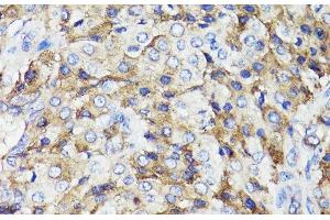 Immunohistochemistry of paraffin-embedded Human lung cancer using CD59 Polyclonal Antibody at dilution of 1:100 (40x lens). (CD59 antibody)