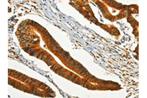The image on the left is immunohistochemistry of paraffin-embedded Human colon cancer tissue using ABIN7190246(CHRDL2 Antibody) at dilution 1/20, on the right is treated with synthetic peptide. (CHRDL2 antibody)