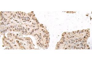 Immunohistochemistry of paraffin-embedded Human thyroid cancer tissue using HMGN2 Polyclonal Antibody at dilution of 1:35(x200) (HMGN2 antibody)