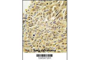 Formalin-fixed and paraffin-embedded human lung carcinoma tissue reacted with Dsk2 Antibody , which was peroxidase-conjugated to the secondary antibody, followed by DAB staining. (Ubiquilin 1 antibody  (N-Term))