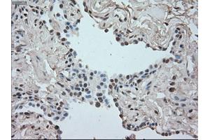 Immunohistochemical staining of paraffin-embedded Adenocarcinoma of breast tissue using anti-SATB1 mouse monoclonal antibody. (SATB1 antibody)