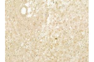 ABIN6260825 and ABIN6277501 at 1/100 staining human astrocytoma by IHC-P. (CHRNB1 antibody  (N-Term))
