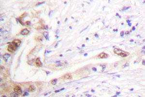Immunohistochemical analysis of paraffin-embedded human lung cancer tissue using TOP2B polyclonal antibody .