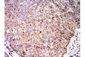 Immunohistochemical analysis of paraffin-embedded bladder cancer tissues using C3C mouse mAb with DAB staining. (Complement C3c antibody  (AA 1521-1649))