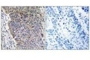 Immunohistochemistry analysis of paraffin-embedded human lung carcinoma tissue using MGST3 antibody. (MGST3 antibody)