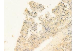 ABIN6258807 and ABIN6273863 at 1/100 staining human hepatocellular carcinoma by IHC-P. (GPR25 antibody  (Internal Region))