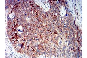 Immunohistochemical analysis of paraffin-embedded cervical cancer tissues using BCL2L10 mouse mAb with DAB staining.