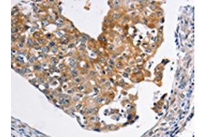 The image on the left is immunohistochemistry of paraffin-embedded Human breast cancer tissue using ABIN7189590(ABCC3 Antibody) at dilution 1/20, on the right is treated with synthetic peptide. (ABCC3 antibody)
