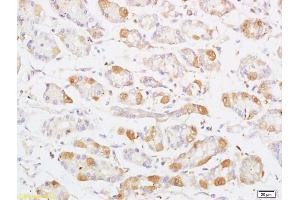 Formalin-fixed and paraffin embedded human colon carcinoma labeled with Anti Phospho-MAP3K8/Tpl2 (Thr290) Polyclonal Antibody, Unconjugated (ABIN746588) at 1:200 followed by conjugation to the secondary antibody and DAB staining (MAP3K8 antibody  (pThr290))