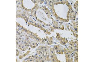 Immunohistochemistry of paraffin-embedded human thyroid cancer using NCF4 Antibody (ABIN1873838) at dilution of 1:100 (40x lens).