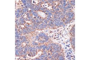 Immunohistochemistry of paraffin-embedded human colon carcinoma using Prohibitin 2 (Prohibitin 2 (PHB2)) Rabbit mAb (ABIN7269545) at dilution of 1:100 (40x lens).