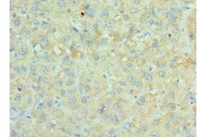 Immunohistochemistry of paraffin-embedded human liver cancer using ABIN7170676 at dilution of 1:100 (SRPK1 antibody  (AA 290-480))