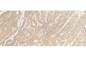 Immunohistochemistry of paraffin-embedded Human liver cancer tissue using WDR6 Polyclonal Antibody at dilution of 1:35(x200) (WDR6 antibody)
