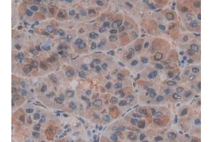 Detection of MIF in Human Liver cancer Tissue using Polyclonal Antibody to Macrophage Migration Inhibitory Factor (MIF) (MIF antibody  (AA 3-111))