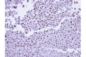 IHC-P Image Immunohistochemical analysis of paraffin-embedded CL1-5 xenograft, using POLR2G, antibody at 1:500 dilution.