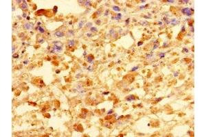 Immunohistochemistry of paraffin-embedded human melanoma using ABIN7148172 at dilution of 1:100 (CCDC91 antibody  (AA 1-180))