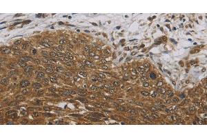 Immunohistochemistry of paraffin-embedded Human cervical cancer tissue using DCTN3 Polyclonal Antibody at dilution 1:70 (DCTN3 antibody)