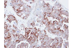 IHC-P Image Immunohistochemical analysis of paraffin-embedded human ovarian carainoma, using Fatty Acid Synthase, antibody at 1:500 dilution. (Fatty Acid Synthase antibody  (N-Term))