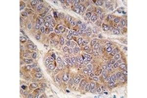 IHC analysis of FFPE human hepatocarcinoma tissue stained with Apolipoprotein A-II antibody (APOA2 antibody  (AA 28-56))