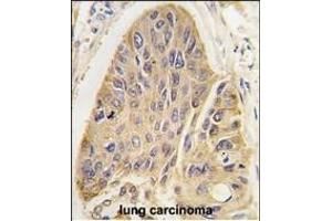 Forlin-fixed and paraffin-embedded hun lung carcino tissue reacted with hP2- antibody, which was peroxidase-conjugated to the secondary antibody, followed by DAB staining. (MAP2 antibody  (C-Term))