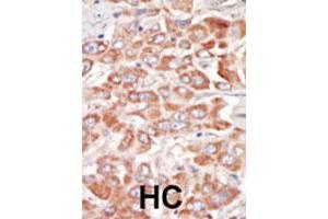 Formalin-fixed and paraffin-embedded human hepatocellular carcinoma tissue reacted with SRPK3 polyclonal antibody  , which was peroxidase-conjugated to the secondary antibody, followed by DAB staining. (SRPK3 antibody  (Internal Region))
