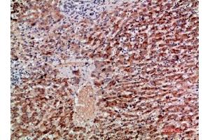 Immunohistochemical analysis of paraffin-embedded human-liver-cancer, antibody was diluted at 1:200. (GDF2 antibody  (AA 371-420))