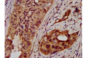 IHC image of ABIN7170786 diluted at 1:400 and staining in paraffin-embedded human cervical cancer performed on a Leica BondTM system. (NSDHL antibody  (AA 154-211))