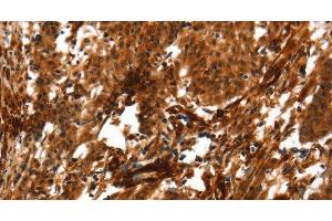 Immunohistochemistry of paraffin-embedded Human gastric cancer using ACTA2 Polyclonal Antibody at dilution of 1:40 (Smooth Muscle Actin antibody)