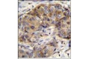 Immunohistochemistry analysis in formalin fixed and paraffin embedded human breast carcinoma reacted with Glutathione reductase Antibody (C-term) followed by peroxidase conjugation of the secondary antibody and DAB staining. (Glutathione Reductase antibody  (C-Term))