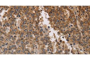 Immunohistochemistry of paraffin-embedded Human liver cancer using KCNK9 Polyclonal Antibody at dilution of 1:40 (KCNK9 antibody)