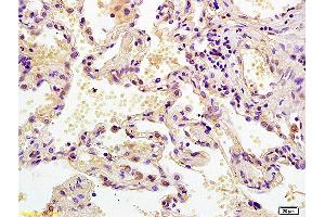 Formalin-fixed and paraffin embedded human lung carcinoma labeled with Anti MEK2/MAPKK2 Polyclonal Antibody, Unconjugated (ABIN726500) at 1:200 followed by conjugation to the secondary antibody and DAB staining. (MEK2 antibody  (AA 1-50))