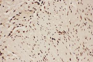 Anti-ALOX5 Picoband antibody,  IHC(P): Human Intestinal Cancer Tissue